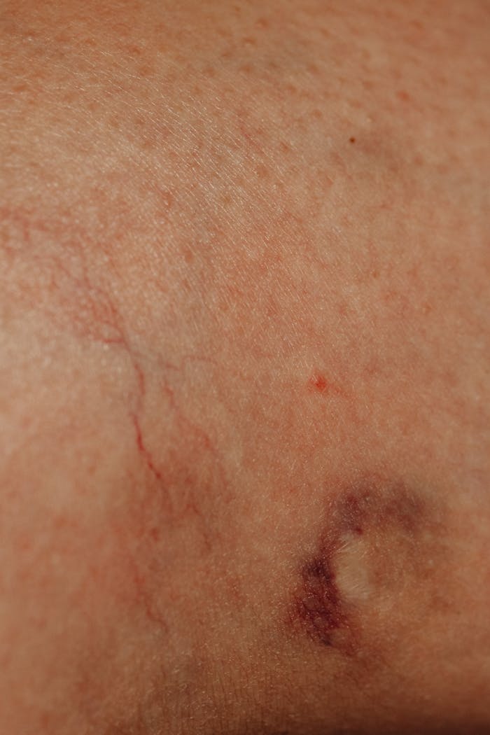 Detailed image depicting a bruise on human skin, showcasing texture and tone variations.