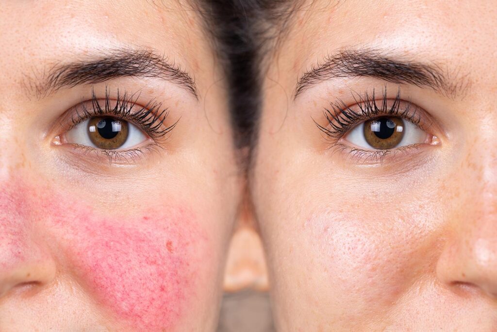 face spider veins before after 2