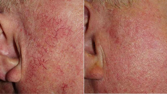 face spider veins before after