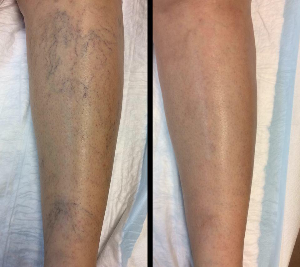 leg spider veins before after