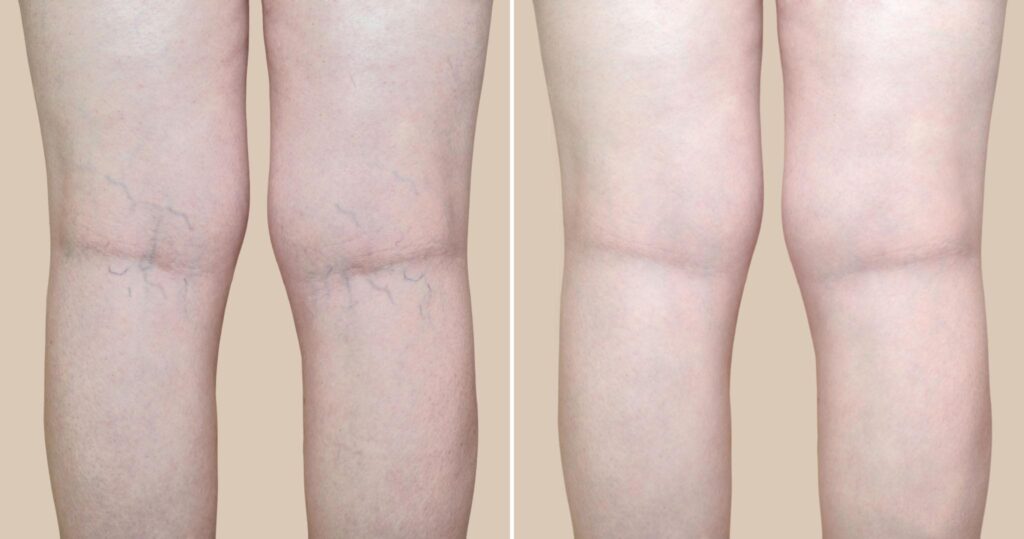 leg spider veins before after
