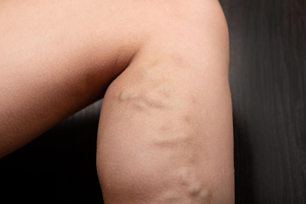 leg varicosities