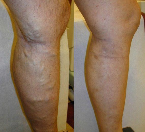 varicose vein before after