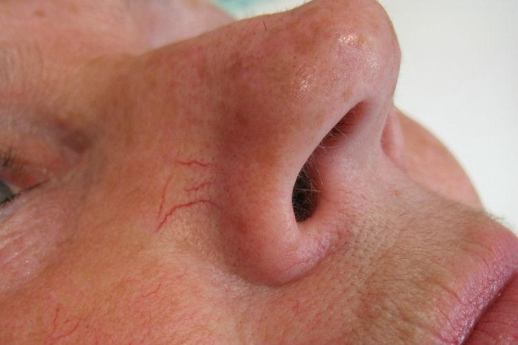 face thread veins