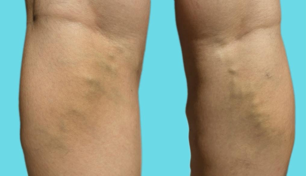 varicose veins image